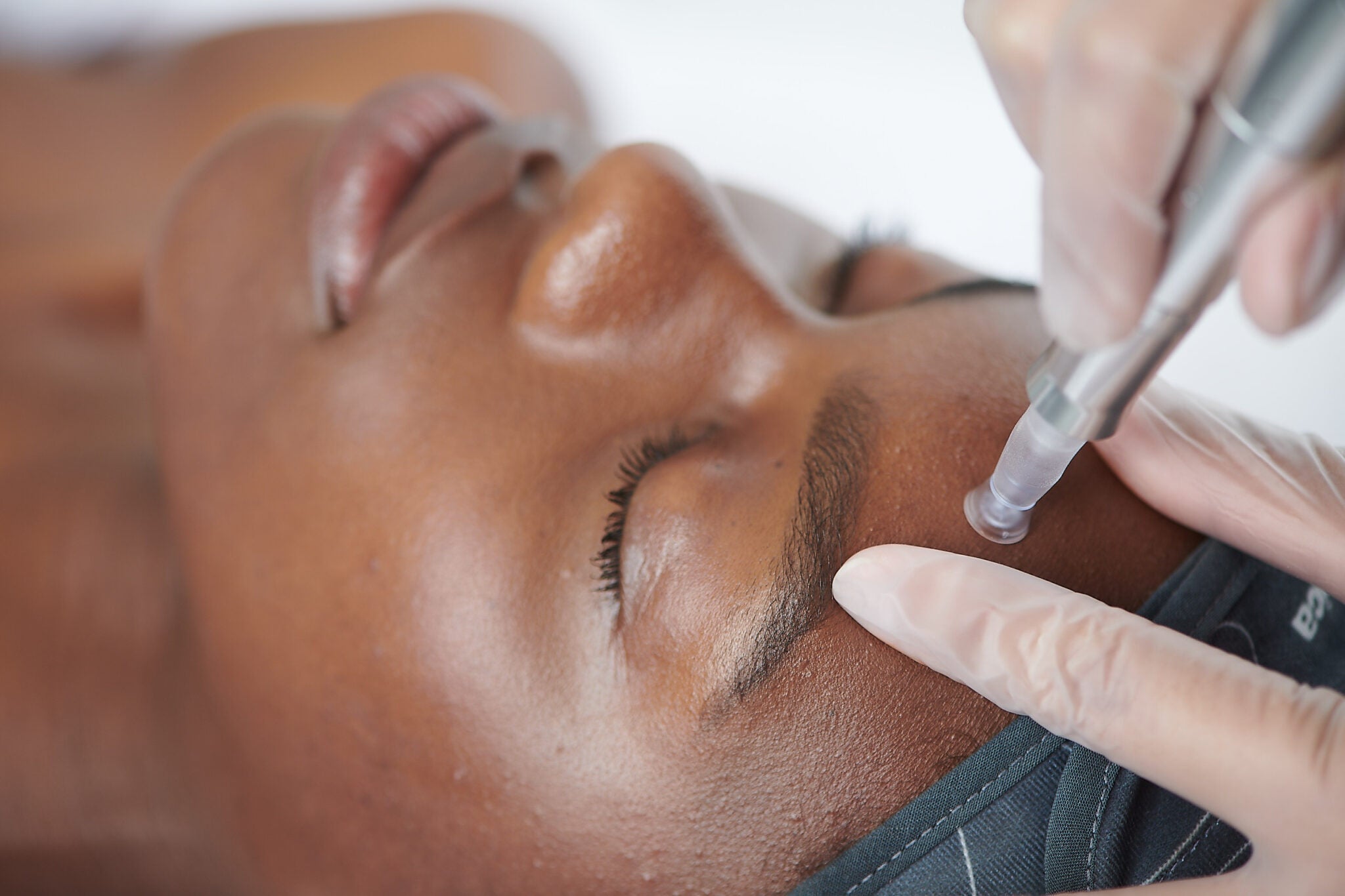 Microneedling - vad händer under huden?